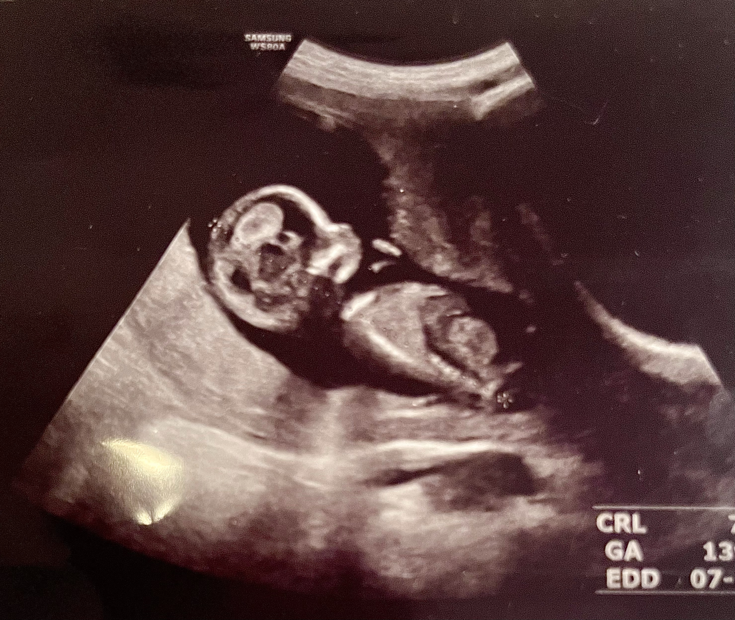 ultrasound-photo-third-pregnancy